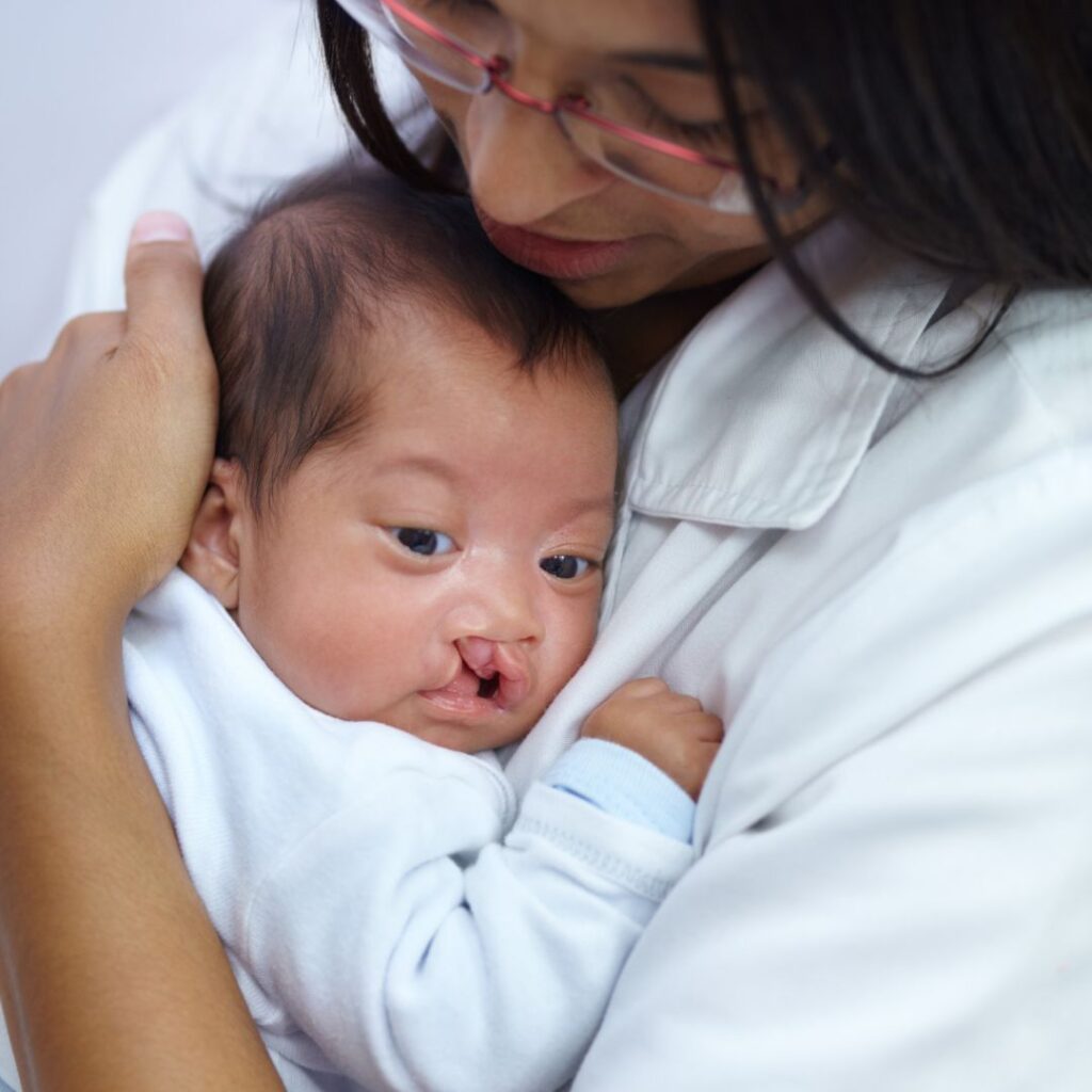 Lady Carrying baby with condition of Cleft Lip and Palate