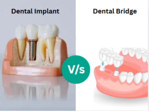 Comparison between dental implant and dental bridge