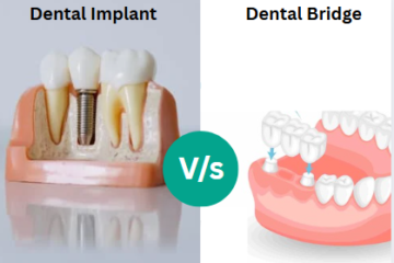 Comparison between dental implant and dental bridge
