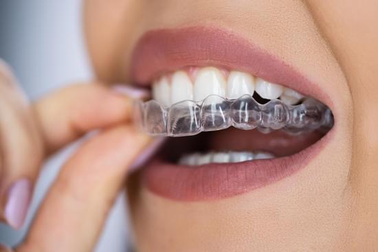 women wearing invisalign