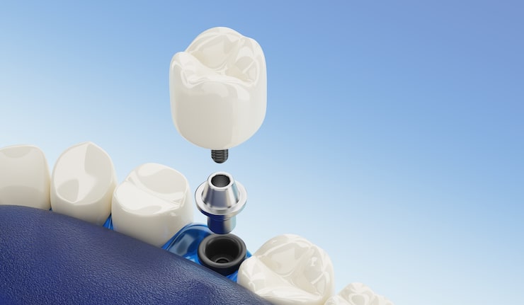 Close up component of dental implants transparent. 3d rendering.