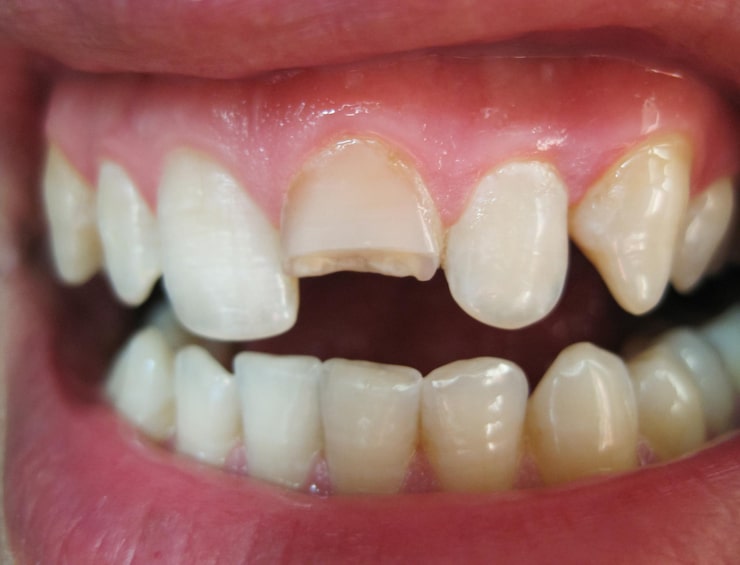 Broken tooth broken upper incisor in a man mouth
